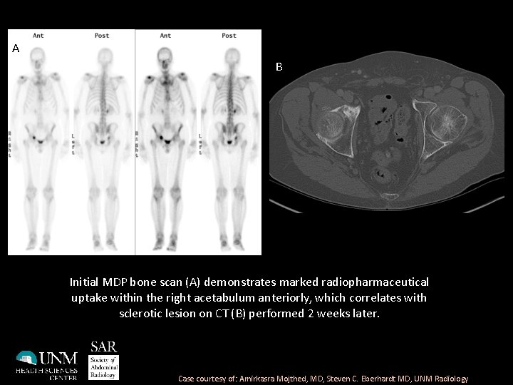 A B Initial MDP bone scan (A) demonstrates marked radiopharmaceutical uptake within the right