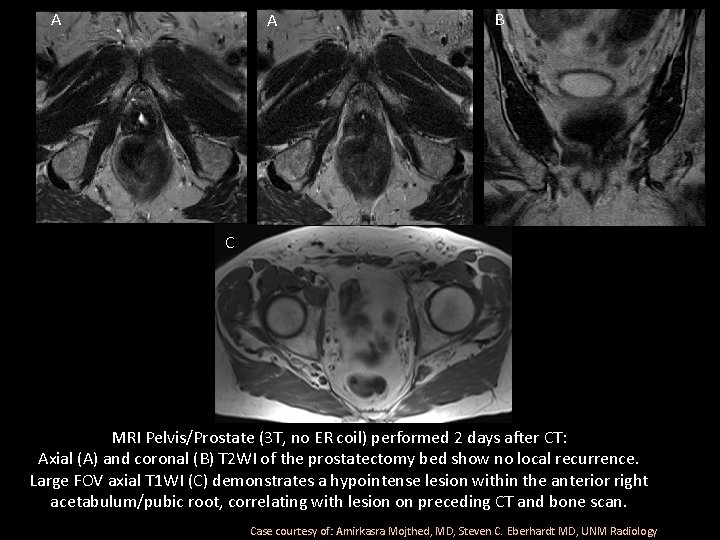 A B C MRI Pelvis/Prostate (3 T, no ER coil) performed 2 days after