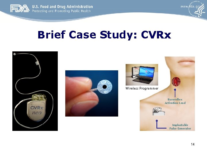 Brief Case Study: CVRx Wireless Programmer Baroreflex Activation Lead Implantable Pulse Generator 14 