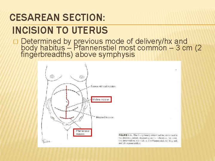 CESAREAN SECTION: INCISION TO UTERUS � Determined by previous mode of delivery/hx and body