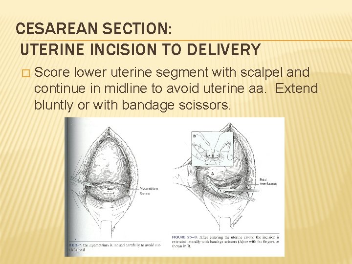 CESAREAN SECTION: UTERINE INCISION TO DELIVERY � Score lower uterine segment with scalpel and