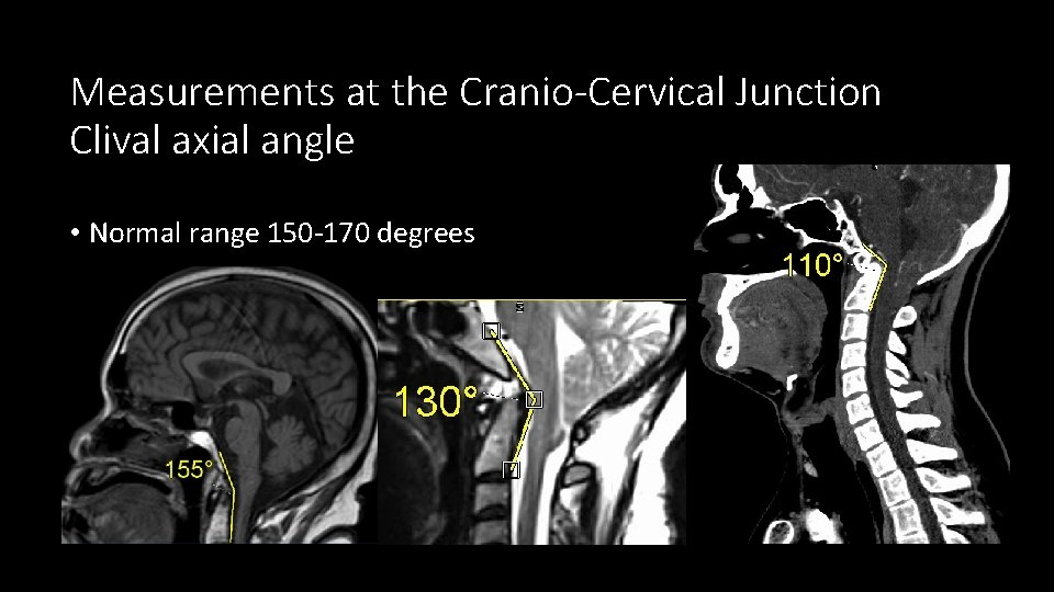 Measurements at the Cranio-Cervical Junction Clival axial angle • Normal range 150 -170 degrees