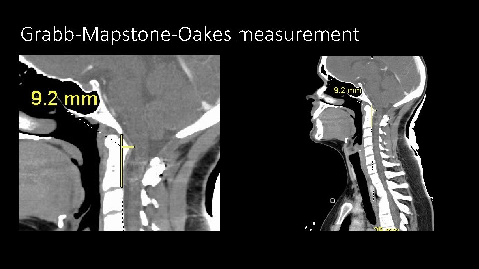 Grabb-Mapstone-Oakes measurement 