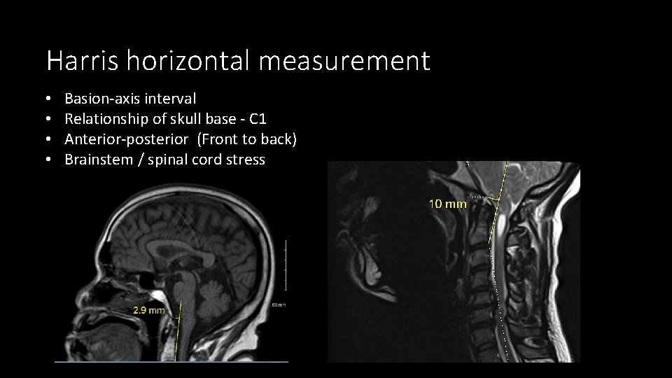 Harris horizontal measurement • • Basion-axis interval Relationship of skull base - C 1