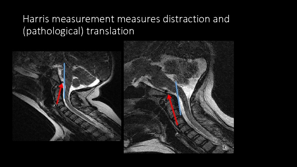 Harris measurement measures distraction and (pathological) translation 