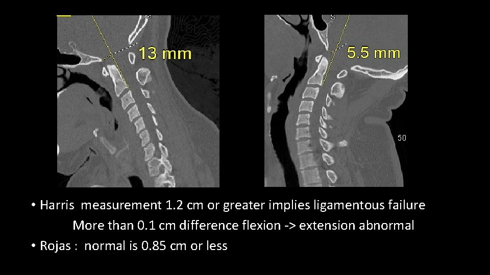  • Harris measurement 1. 2 cm or greater implies ligamentous failure More than