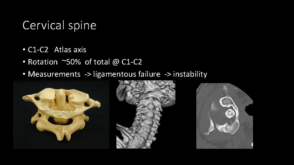 Cervical spine • C 1 -C 2 Atlas axis • Rotation ~50% of total