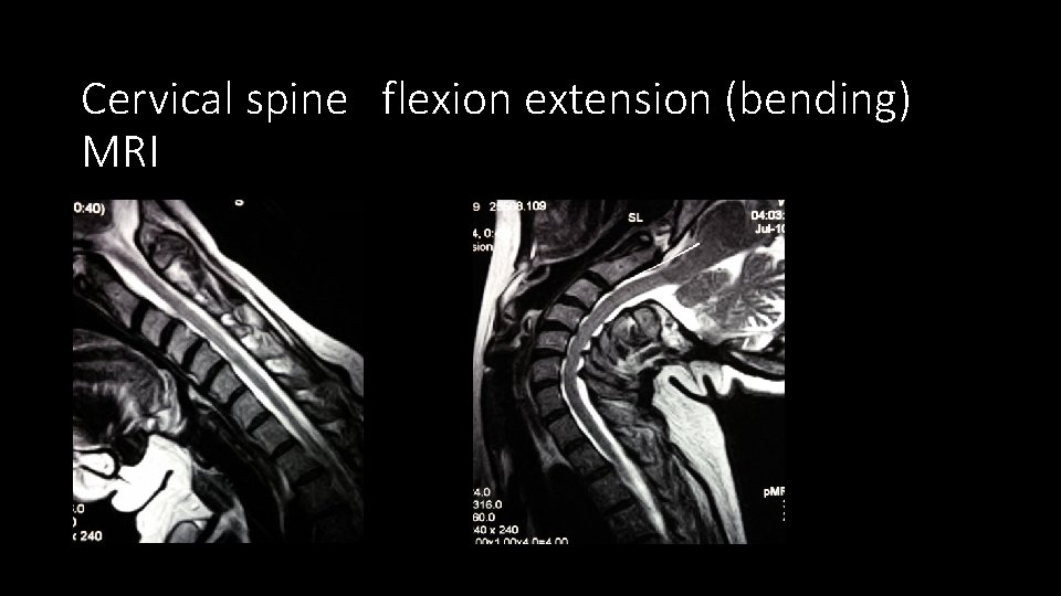 Cervical spine flexion extension (bending) MRI 