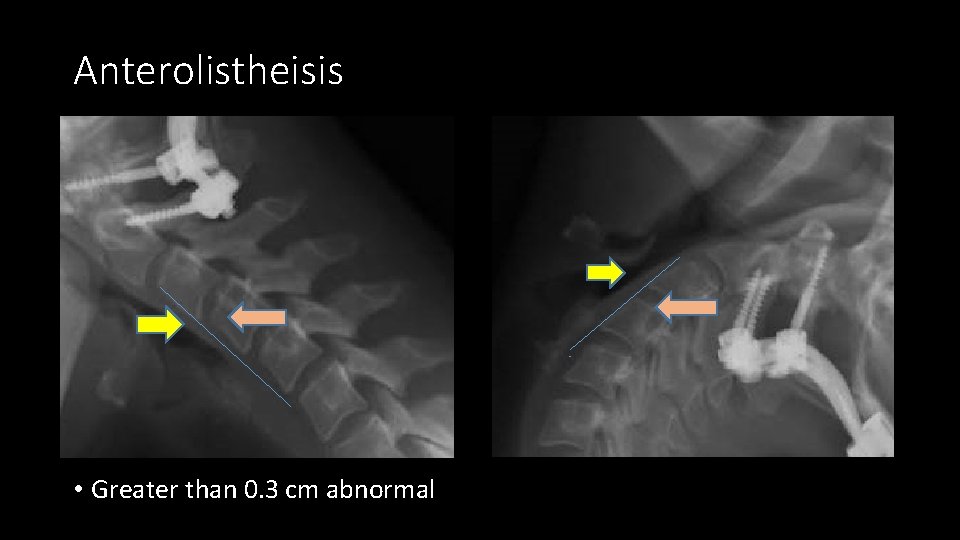 Anterolistheisis • Greater than 0. 3 cm abnormal 