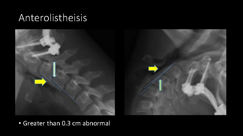 Anterolistheisis • Greater than 0. 3 cm abnormal 