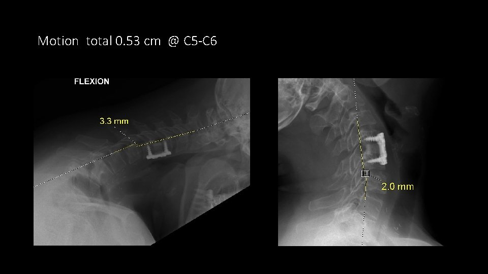 Motion total 0. 53 cm @ C 5 -C 6 