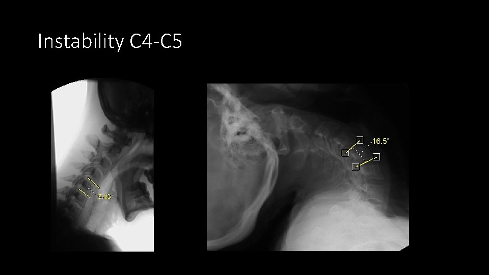 Instability C 4 -C 5 