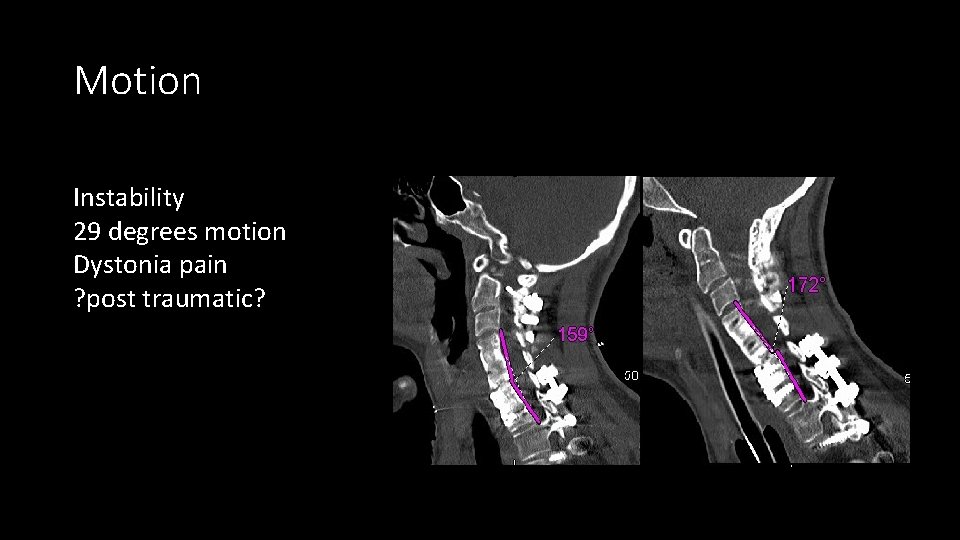 Motion Instability 29 degrees motion Dystonia pain ? post traumatic? 