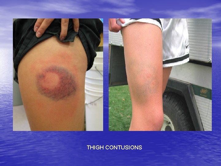 THIGH CONTUSIONS 