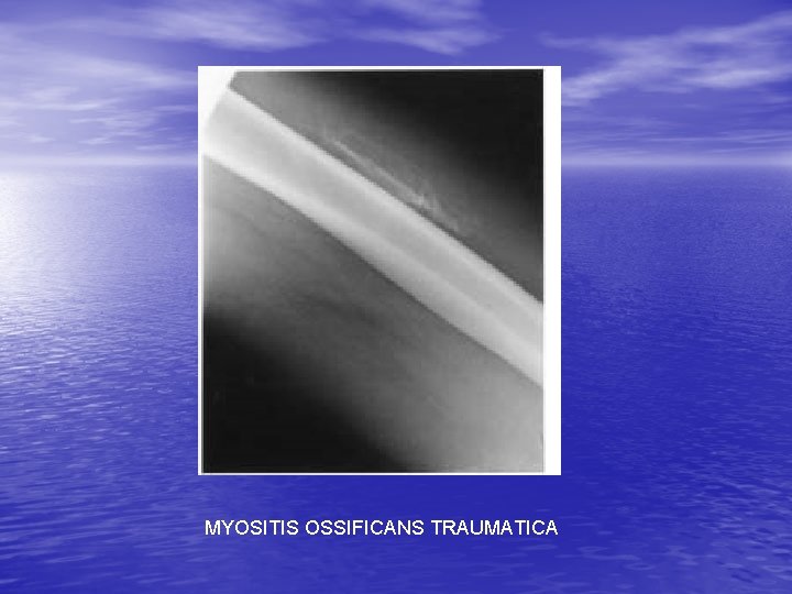 MYOSITIS OSSIFICANS TRAUMATICA 