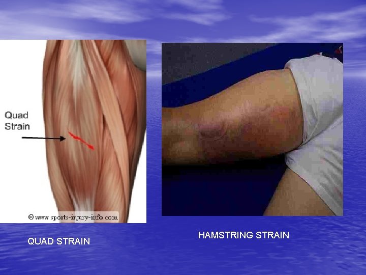 QUAD STRAIN HAMSTRING STRAIN 