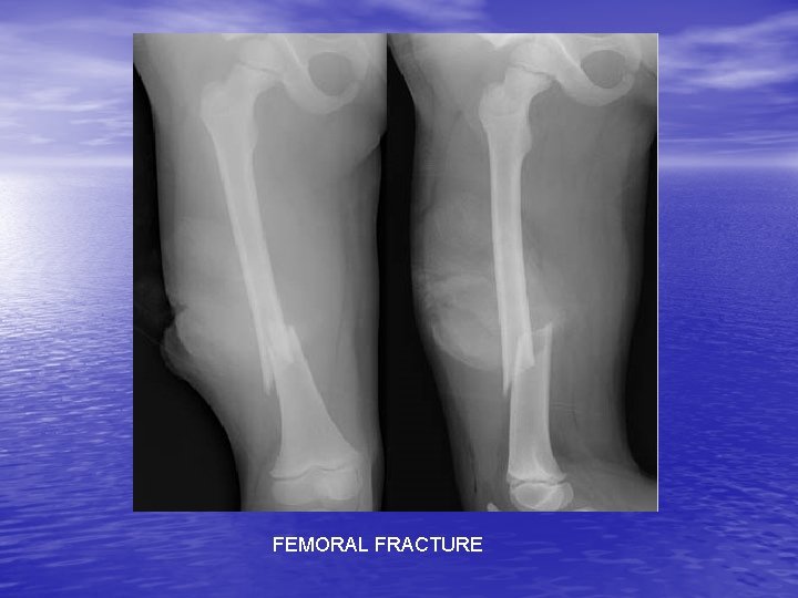 FEMORAL FRACTURE 