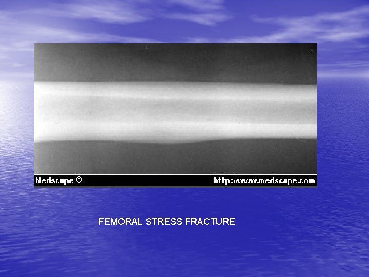 FEMORAL STRESS FRACTURE 