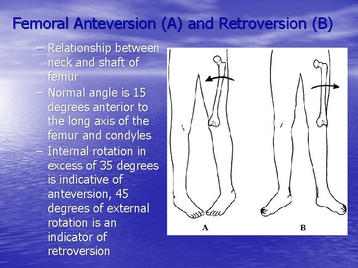 Femoral Anteversion (A) and Retroversion (B) – Relationship between neck and shaft of femur