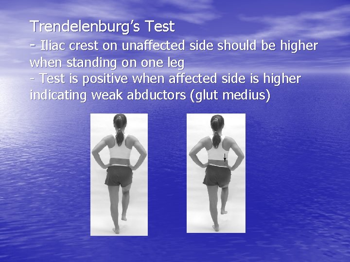 Trendelenburg’s Test - Iliac crest on unaffected side should be higher when standing on