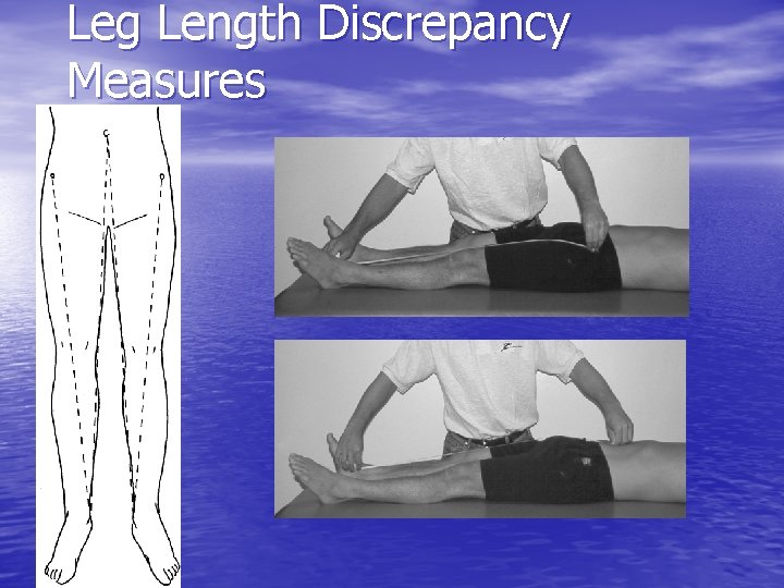 Leg Length Discrepancy Measures 