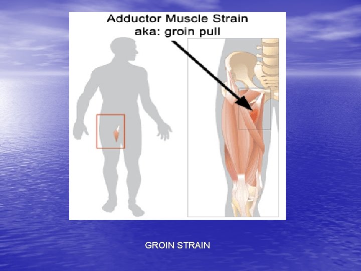 GROIN STRAIN 