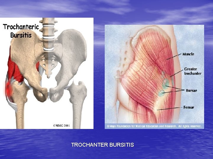 TROCHANTER BURSITIS 