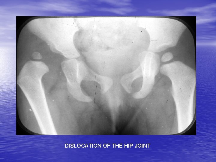 DISLOCATION OF THE HIP JOINT 