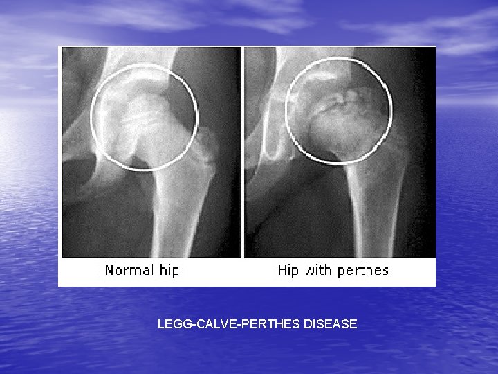 LEGG-CALVE-PERTHES DISEASE 