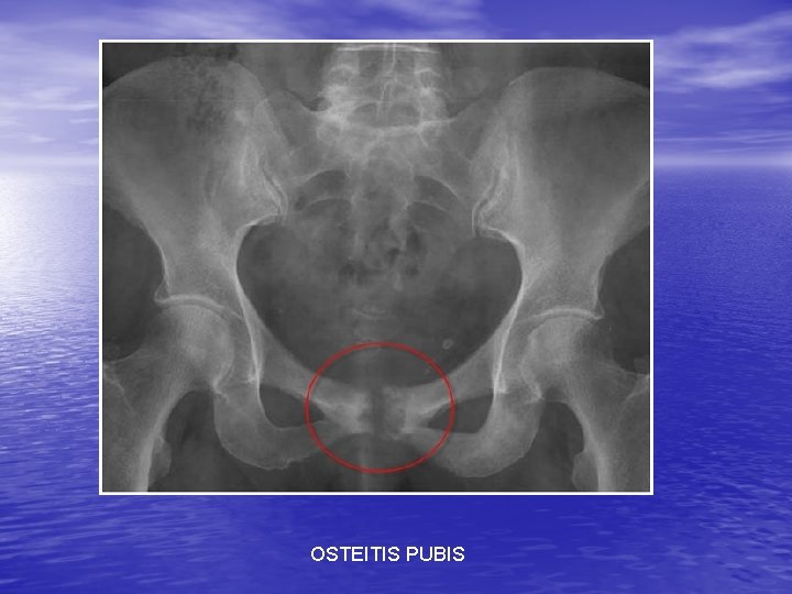 OSTEITIS PUBIS 