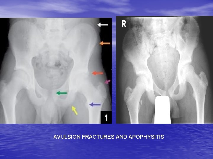 AVULSION FRACTURES AND APOPHYSITIS 