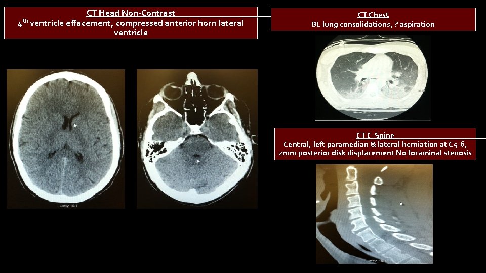 CT Head Non-Contrast CT Chest th 4 ventricle effacement, compressed anterior horn lateral BL