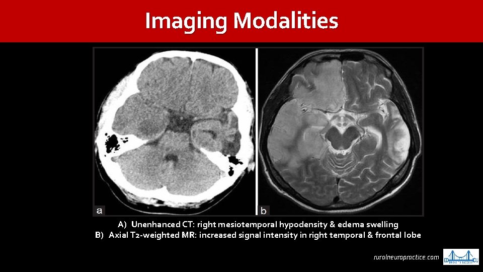Imaging Modalities A) Unenhanced CT: right mesiotemporal hypodensity & edema swelling B) Axial T