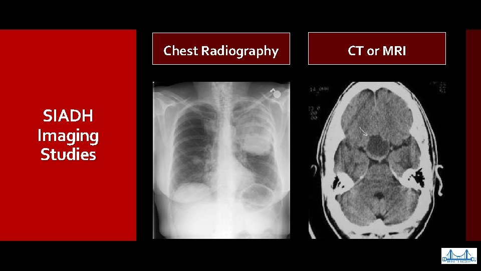 Chest Radiography SIADH Imaging Studies CT or MRI 