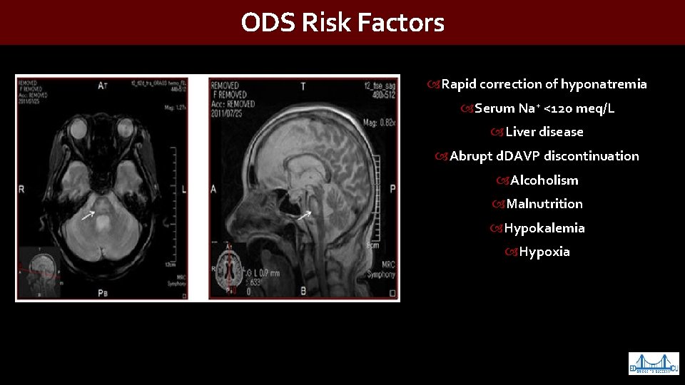 ODS Risk Factors Rapid correction of hyponatremia Serum Na+ <120 meq/L Liver disease Abrupt