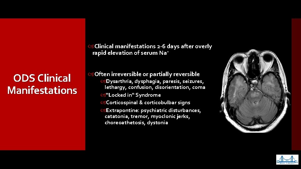  Clinical manifestations 2 -6 days after overly rapid elevation of serum Na+ ODS