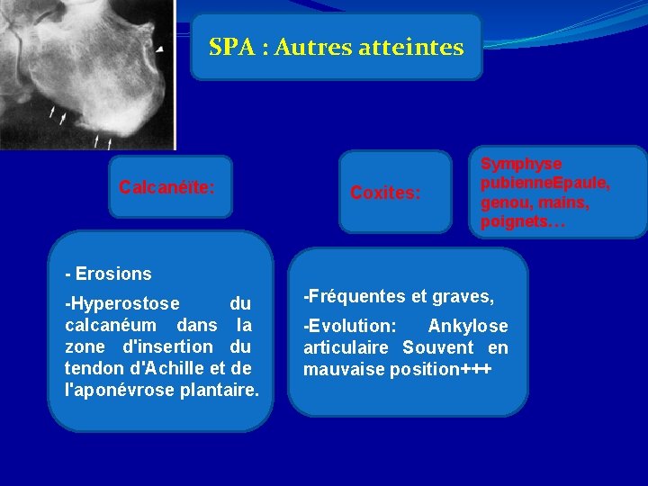 SPA : Autres atteintes Calcanéïte: Coxites: Symphyse pubienne. Epaule, genou, mains, poignets… - Erosions