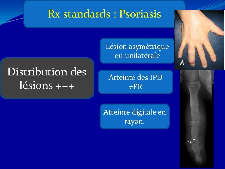 Rx standards : Psoriasis Lésion asymétrique ou unilatérale Distribution des lésions +++ Atteinte des