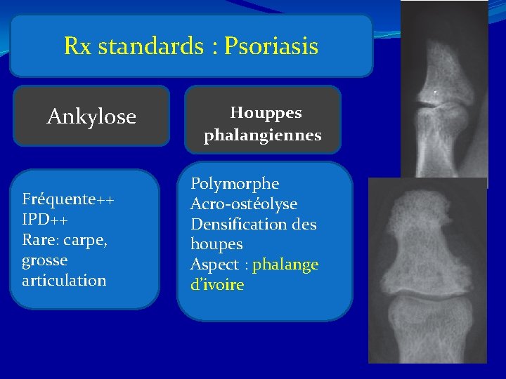 Rx standards : Psoriasis Ankylose Fréquente++ IPD++ Rare: carpe, grosse articulation Houppes phalangiennes Polymorphe