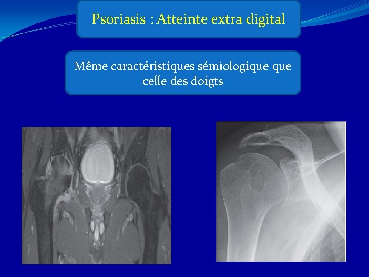 Psoriasis : Atteinte extra digital Même caractéristiques sémiologique celle des doigts 