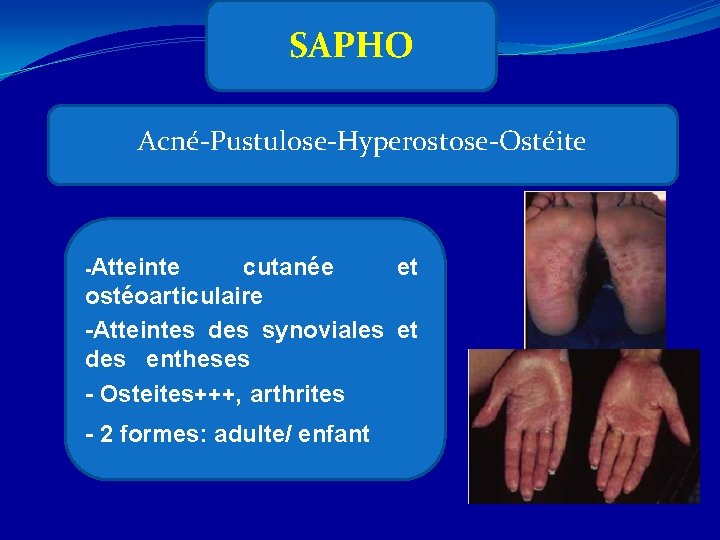 SAPHO Acné-Pustulose-Hyperostose-Ostéite -Atteinte cutanée et ostéoarticulaire -Atteintes des synoviales et des entheses - Osteites+++,