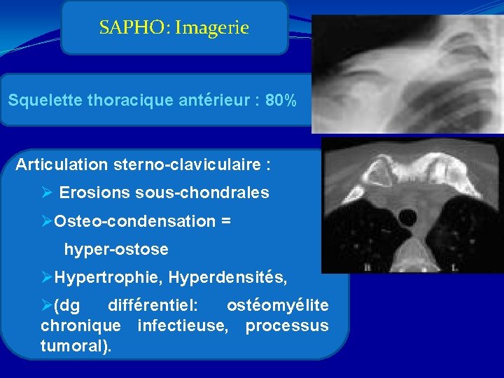 SAPHO: Imagerie Squelette thoracique antérieur : 80% Articulation sterno-claviculaire : Ø Erosions sous-chondrales ØOsteo-condensation