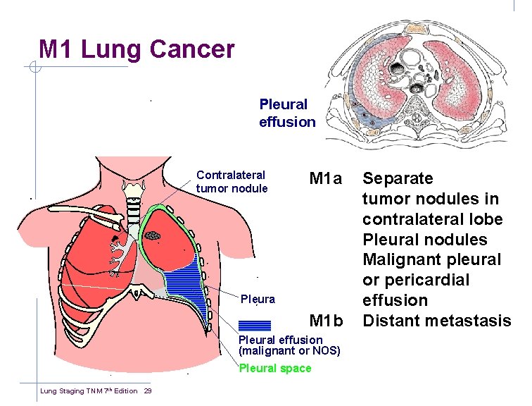 M 1 Lung Cancer Pleural effusion Contralateral tumor nodule M 1 a Pleura M