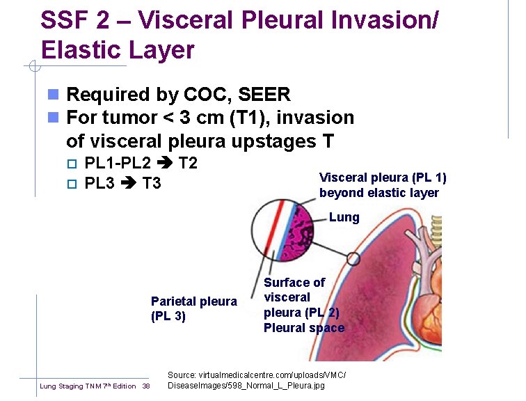 SSF 2 – Visceral Pleural Invasion/ Elastic Layer n Required by COC, SEER n