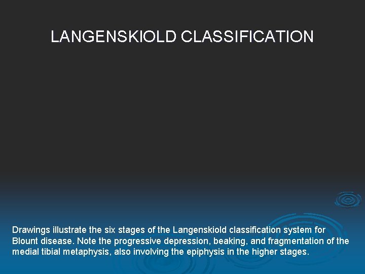 LANGENSKIOLD CLASSIFICATION Drawings illustrate the six stages of the Langenskiold classification system for Blount