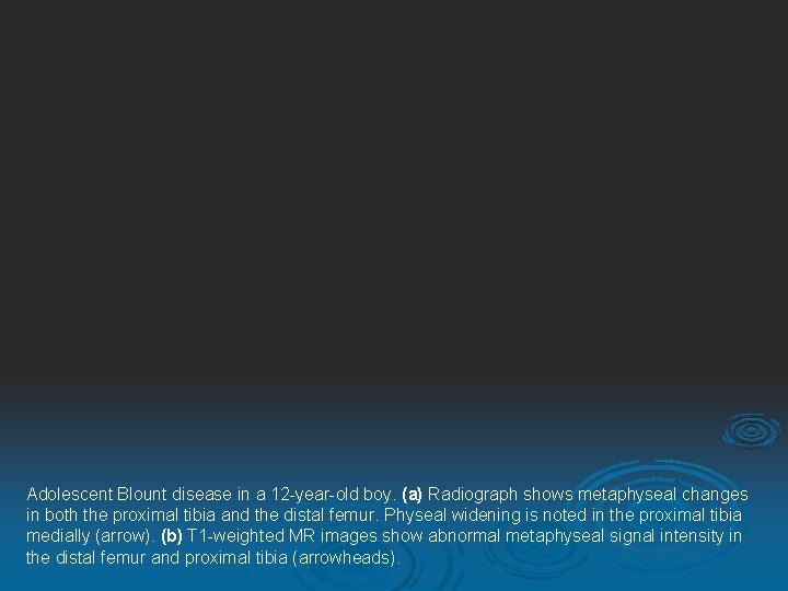 Adolescent Blount disease in a 12 -year-old boy. (a) Radiograph shows metaphyseal changes in
