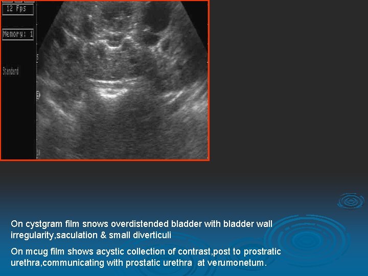 On cystgram film snows overdistended bladder with bladder wall irregularity, saculation & small diverticuli