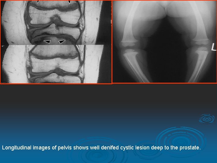 Longitudinal images of pelvis shows well denifed cystic lesion deep to the prostate. 