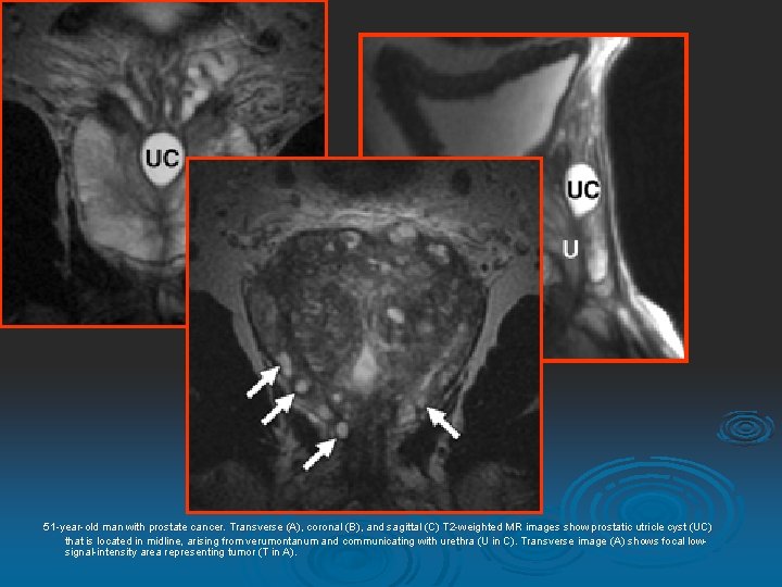 51 -year-old man with prostate cancer. Transverse (A (A), coronal (B (B), and sagittal