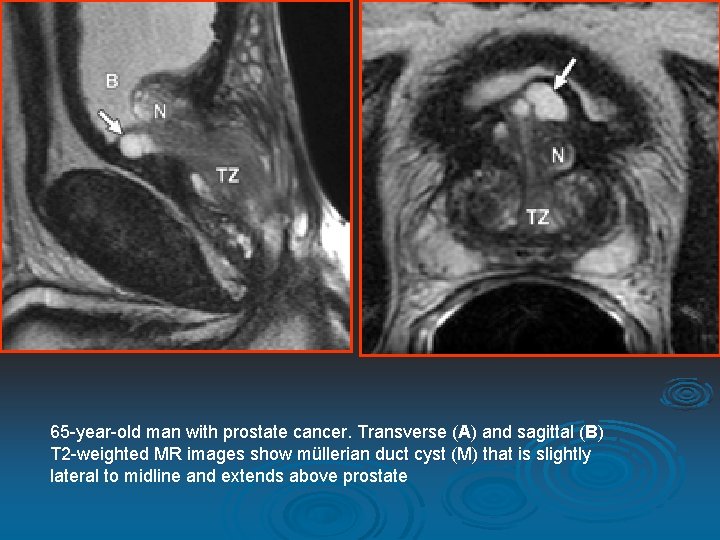 65 -year-old man with prostate cancer. Transverse (A) and sagittal (B) T 2 -weighted